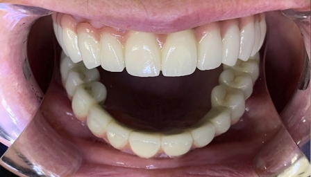 Удаление зубов