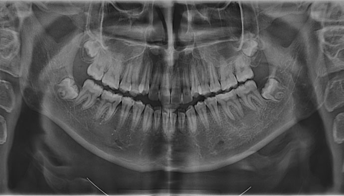 Лечение периодонтита
