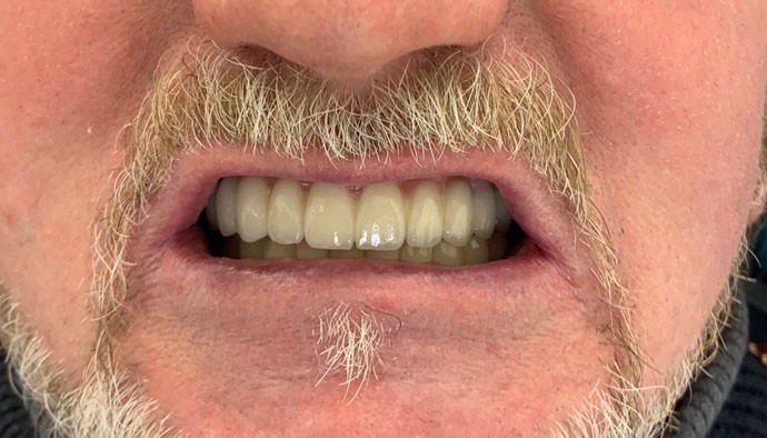 Профгигиена полости рта