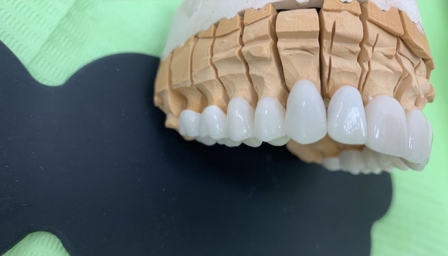 Металлокерамические коронки