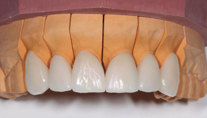 Реставрация передних зубов