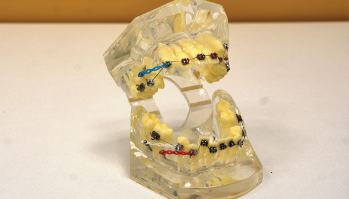 Протезирование зубов