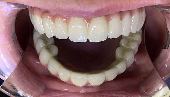 Удаление зубов