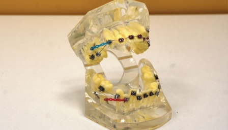 Протезирование зубов