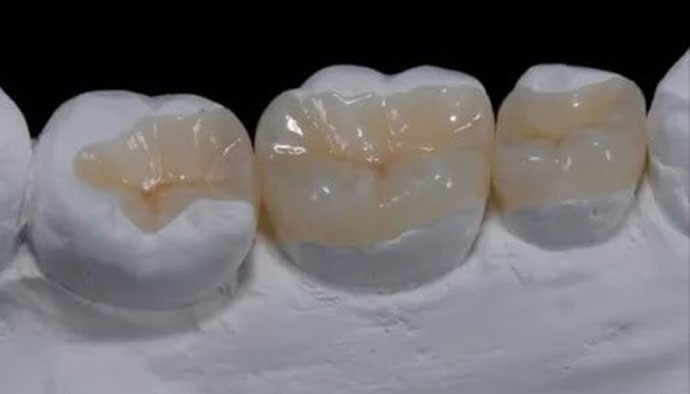 Безметалловая керамика (циркон)